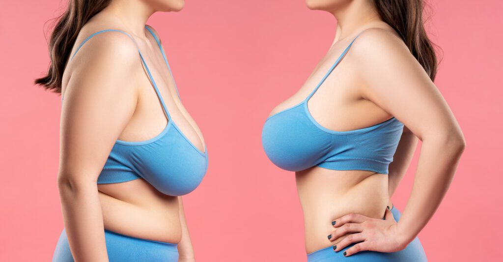 breast-lift-1024x533-3